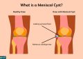 Meniscal-Cyst-Symptoms-and-Knee-Support