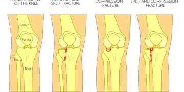 What-are-the-causes-of-knee-fracture