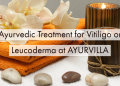 Ayurvedic treatment for vitiligo