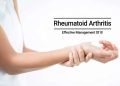 Depth details about rheumatoid arthritis A complete outline, indication, effects, therapy, and many more