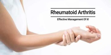 Depth details about rheumatoid arthritis A complete outline, indication, effects, therapy, and many more