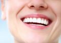 best teeth whitening clinic in dubai
