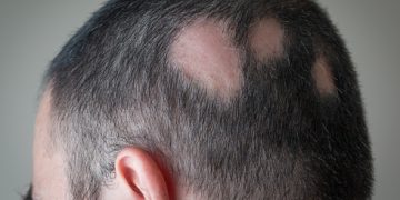 Hair Loss Due To Alopecia Areata