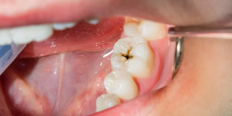 teeth whitening in Punjab