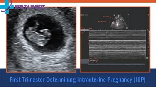 Intrauterine Pregnancy